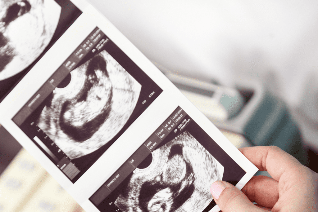 Zwanger van een drieling: (emotionele) rollercoaster en slecht nieuws!